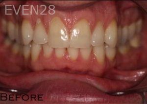 Joyce-Kahng-Teeth-Whitening-before-1