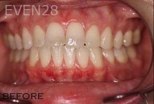 Joyce-Kahng-Teeth-Whitening-before-2