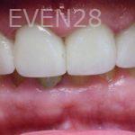 Kareem-Abraham-Dental-Crowns-after-2