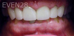 Kareem-Abraham-Dental-Crowns-after-2