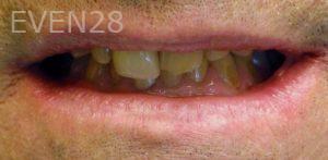 Kareem-Abraham-Dental-Crowns-before-1