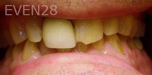 Kareem-Abraham-Dental-Crowns-before-2