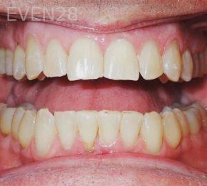 Kareem-Abraham-Teeth-Whitening-after-1