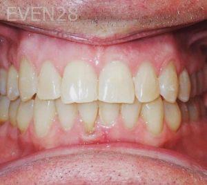 Kareem-Abraham-Teeth-Whitening-after-1b