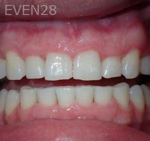 Kareem-Abraham-Teeth-Whitening-after-2