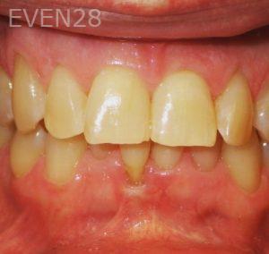Kareem-Abraham-Teeth-Whitening-before-1