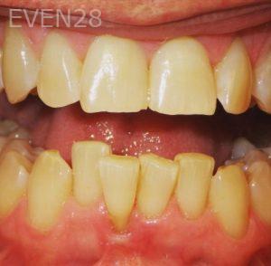 Kareem-Abraham-Teeth-Whitening-before-1b