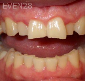 Kareem-Abraham-Teeth-Whitening-before-2