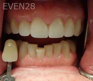 Kareem-Abraham-Teeth-Whitening-before-3