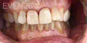 Kaveh-Niknia-Dental-Crowns-after-2