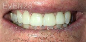 Kaveh-Niknia-Dental-Crowns-after-3
