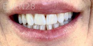 Kaveh-Niknia-Dental-Crowns-before-1