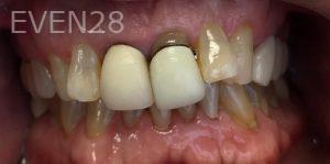 Kaveh-Niknia-Dental-Crowns-before-2