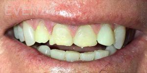 Kaveh-Niknia-Dental-Crowns-before-3