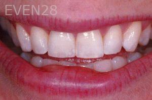 Kaveh-Niknia-Dental-Implant-after-1