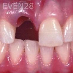 Kaveh-Niknia-Dental-Implant-before-1