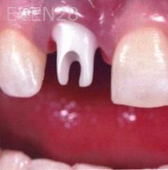 Kaveh-Niknia-Dental-Implant-before-1b