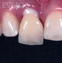 Kaveh-Niknia-Dental-Implant-before-1c