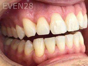 Kaveh-Niknia-Invisalign-clear-aligners-after-1
