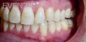 Kaveh-Niknia-Invisalign-clear-aligners-after-2