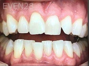 Kaveh-Niknia-Invisalign-clear-aligners-before-1