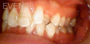Kaveh-Niknia-Invisalign-clear-aligners-before-2