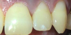 Kaveh-Niknia-White-Fillings-after-1