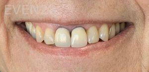 Kelly-Gibson-dental-crown-before-2