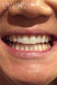 Kenneth-Whelan-Teeth-Whitening-after-1