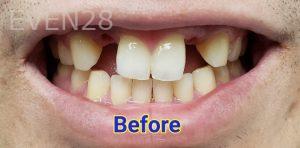 Kevin-Kwam-Dental-Implants-before-1
