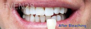 Kevin-Kwam-Teeth-Whitening-after-2