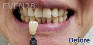 Kevin-Kwam-Teeth-Whitening-before-1