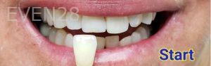 Kevin-Kwam-Teeth-Whitening-before-2