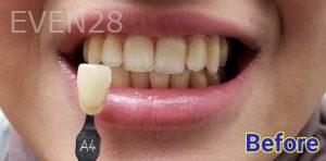 Kevin-Kwam-Teeth-Whitening-before-3