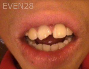 Khoi-Nguyen-Dental-Bonding-before-1