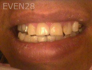 Khoi-Nguyen-Dental-Crowns-after-1