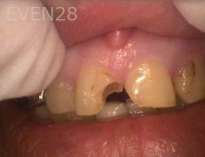 Khoi-Nguyen-Dental-Crowns-before-1