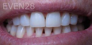 Kristen-Ritzau-Dental-Bonding-before-1
