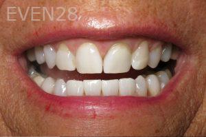 Kristen-Ritzau-Teeth-Whitening-after-1