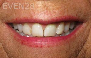 Kristen-Ritzau-Teeth-Whitening-before-1