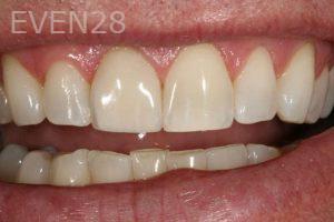Kurt-Schneider-Dental-Crowns-after-2