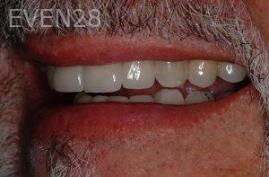 Kurt-Schneider-Dental-Crowns-after-8