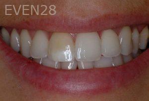 Kurt-Schneider-Dental-Crowns-before-1