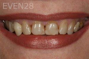 Kurt-Schneider-Dental-Crowns-before-10