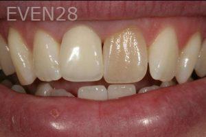 Kurt-Schneider-Dental-Crowns-before-11