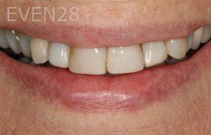 Kurt-Schneider-Dental-Crowns-before-12