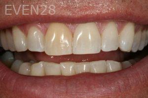 Kurt-Schneider-Dental-Crowns-before-2
