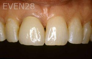 Kurt-Schneider-Dental-Crowns-before-5
