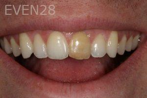 Kurt-Schneider-Dental-Crowns-before-6