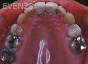 Kurt-Schneider-Dental-Crowns-before-7